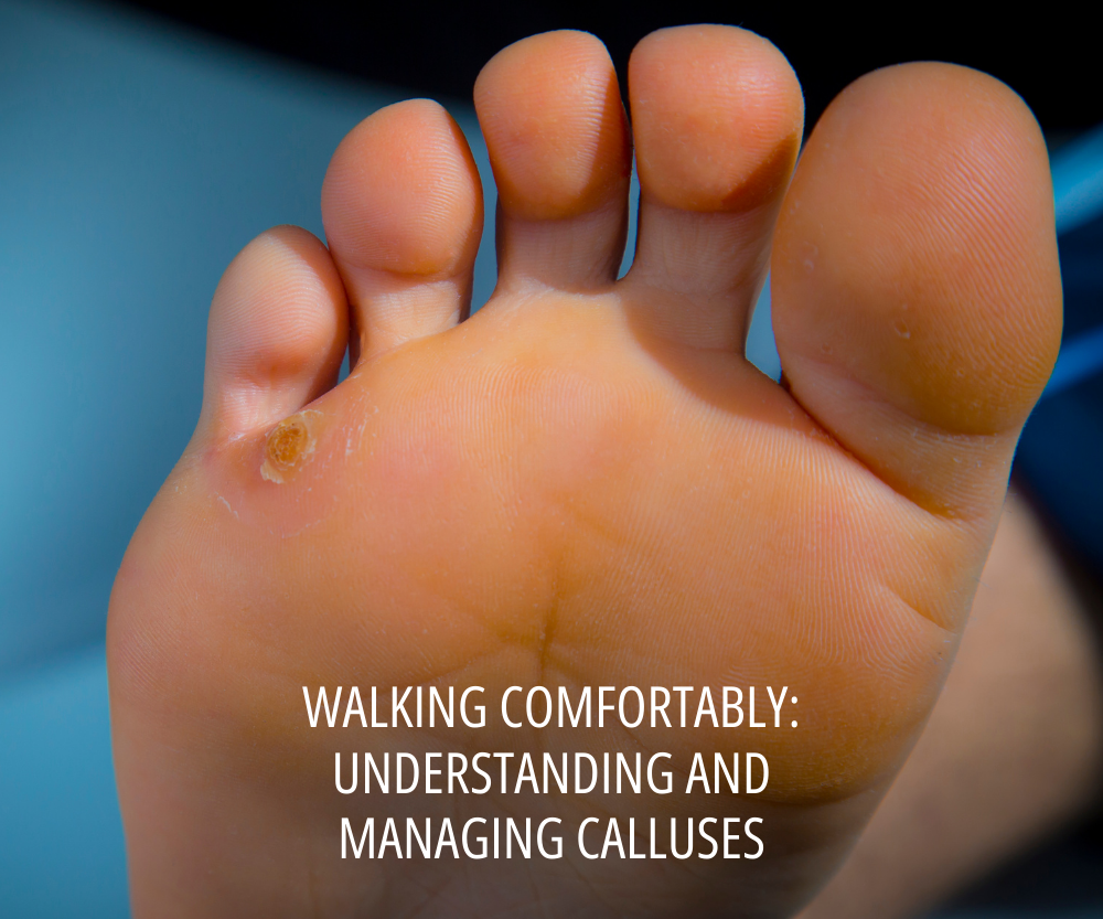 Walking Comfortably Understanding and Managing Calluses
